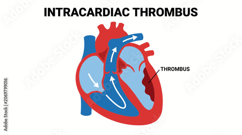 Quadro su tela Intracardiac Thrombus Formation Heart Chamber Vector