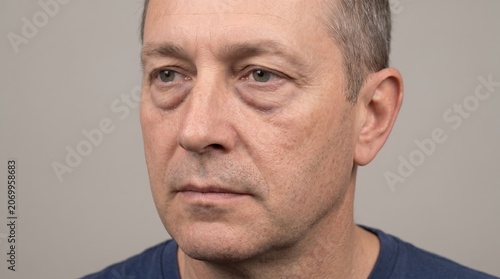 Portrait of middle aged man with prominent infraorbital puffiness dark circles and tired under eye bags