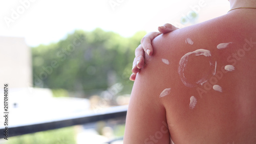 Foto Woman with red sunburned skin on shoulder and back applying moisturizing after sun lotion, skincare treatment after excessive sun exposure
