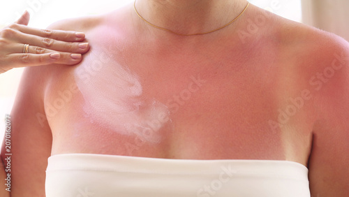 Tableau sur toile Woman with painful sunburned skin on chest and shoulders after summer vacation, close-up of red irritated skin with tan lines, after sun care and UV protection concept