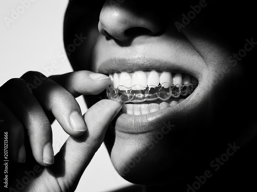 Clear plastic dental aligner or invisible braces for teeth straightening treatment. For dental clinics, orthodontic marketing, healthcare campaigns, cosmetic dentistry, and oral wellness