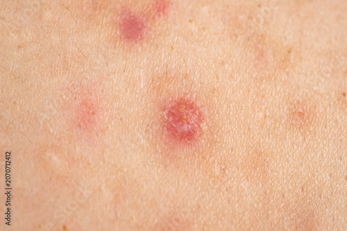 Fotografi Blemishes with visible pores