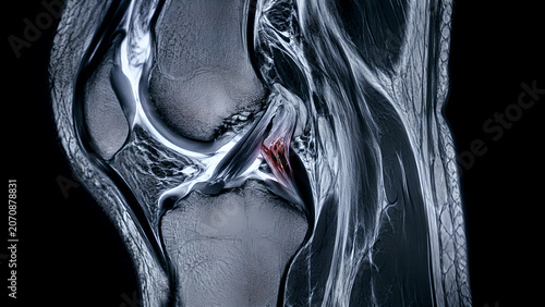 Knee PCL injury radiology concept with posterior cruciate ligament tear in MRI style medical imaging of knee joint for orthopedic diagnosis, sports medicine education, and patient care design use