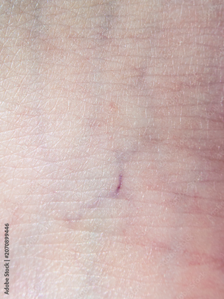 Fototapeta premium Close up view of early stage varicose veins on caucasian human skin