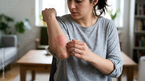 Woman scratching itchy arm with rash, skin allergy, eczema, discomfort