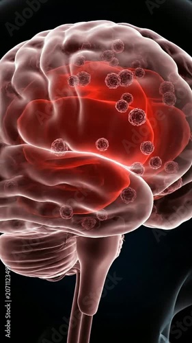 Realistic Anatomical Visualization of Meningitis Infection in Human Brain Highlighting Red Areas Against Black Background