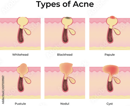 Types of Acne Diagram