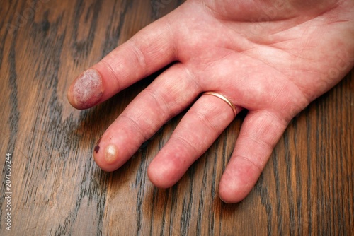 Hand showing fingers with blisters from burn injury