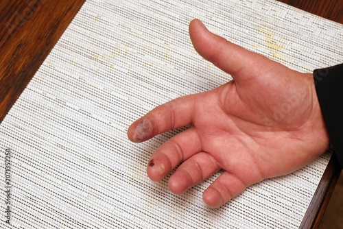 Person's hand displaying blisters from finger burns
