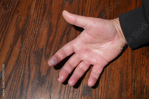 Hand showing burn injury on finger with blisters