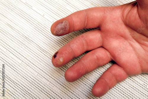 Human hand after burn injury showing blisters