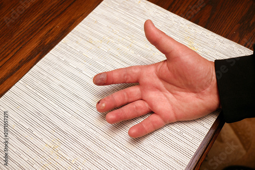 Hand with second degree burn blisters on fingers