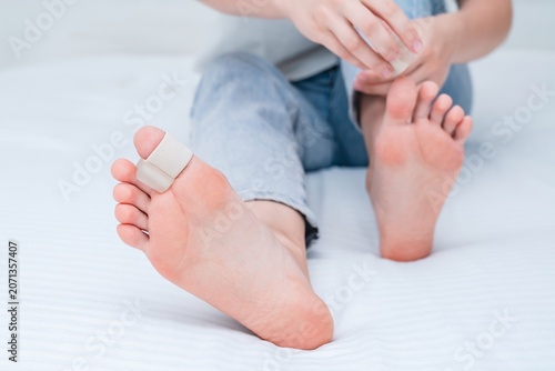 Woman's leg with silicone finger separator. To treat and prevent of hallux valgus