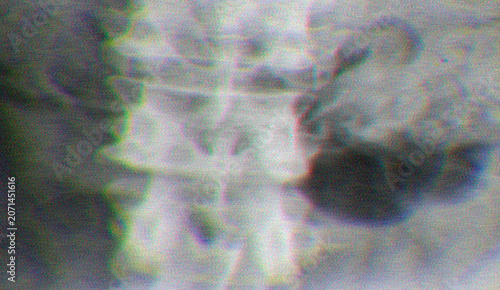 Stylized X-ray of human spine vertebrae with medical radiology look, enhanced with chromatic aberration glitch and neon color split on dark background style 3D