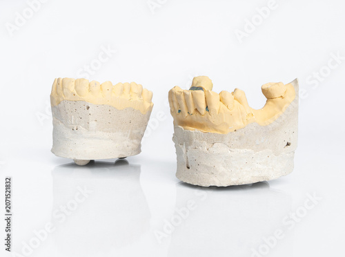 Upper and lower dental plaster casts for prosthetic planning