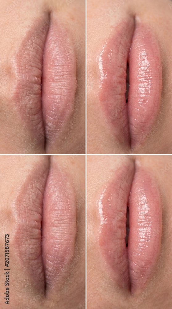Naklejka premium Dry lip lip care hydration before and after close up natural healthy skin cosmetic beauty repair clinical