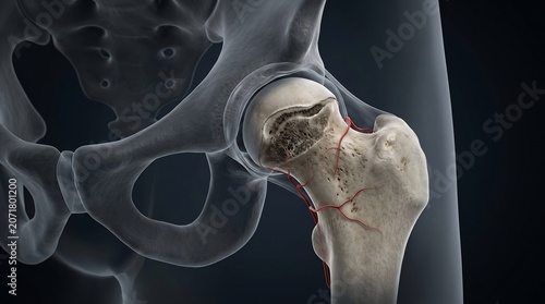 Femoral neck fracture appears as a highlighted medical illustration demonstrating a break in the hip bone structure.