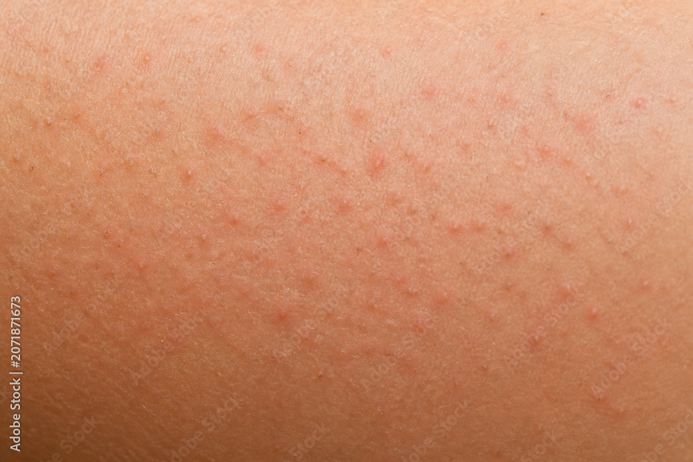 Fototapeta premium Close-up of human skin exhibiting numerous small red bumps, likely a rash or irritation.