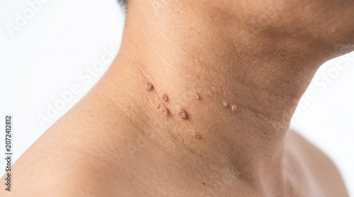 Macro View of Viral Warts and Skin Lesions on Adult Neck Skin