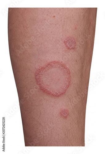 Close Up View of Circular Red Rash on Human Skin