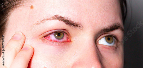 Tableau sur toile Conjunctivitis making eye bloodshot and swollen