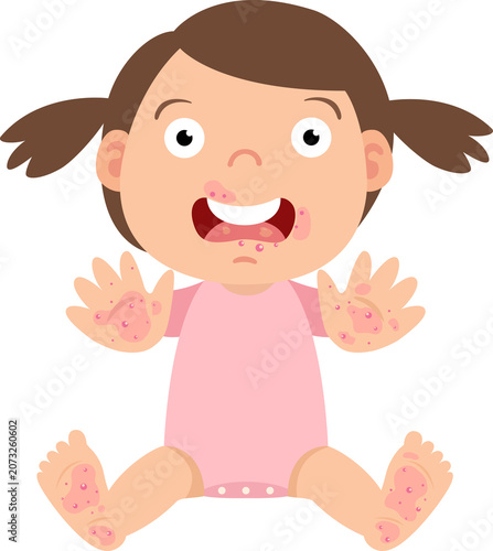 Hand, Foot and Mouth Disease in Children Illustration