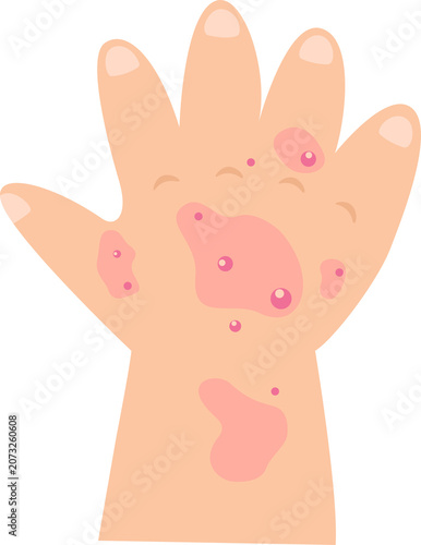 Hand, Foot and Mouth Disease in Children Illustration