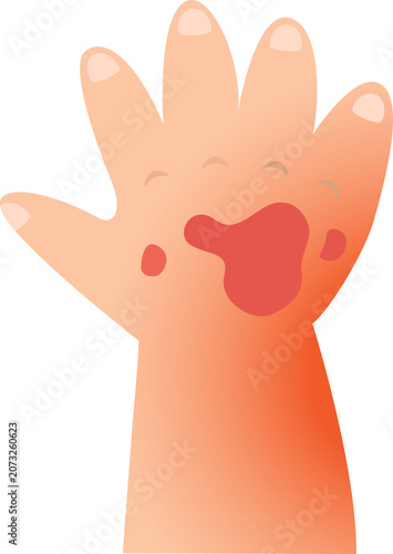 Baby Hand Skin Burn Illustration