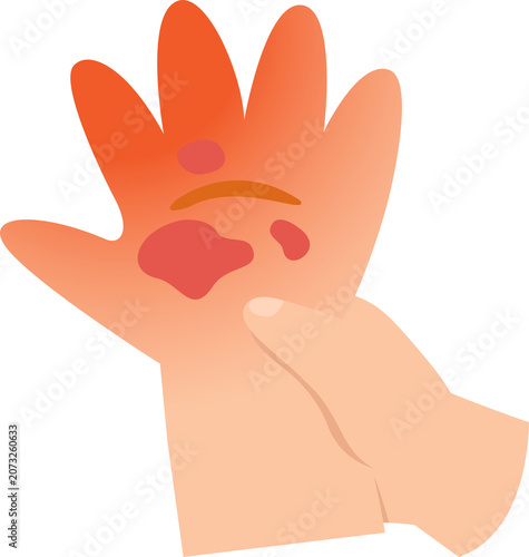 Baby Hand Skin Burn Illustration