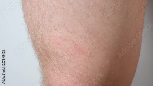 Erythema migrans rash caused by Lyme disease. Borreliosis symptom.