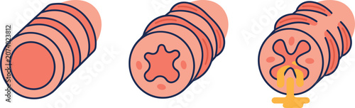 Foto Human Bronchi Cross Section Diagram Showing Progressive Asthma Stages with Norma