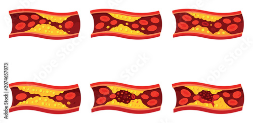 Plaque builds up in blood vessels, narrowing arteries and forming thrombus that blocks flow