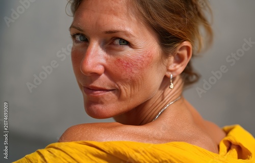 A woman with light brown hair and visible sunburn on her face looks back towards the camera, highlighting skin damage from UV exposure