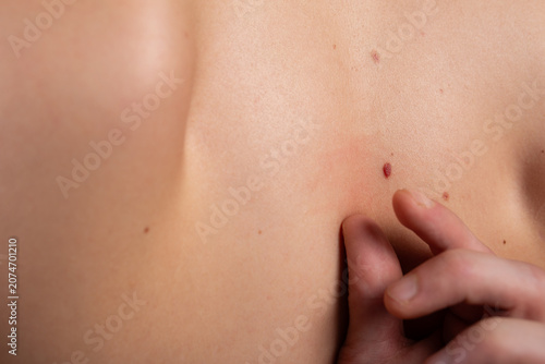 Bild auf Leinwand A mole and spots on the young man's back