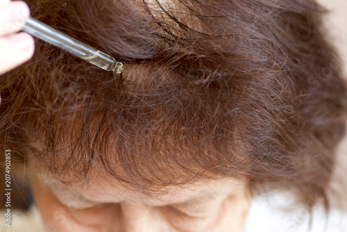Photos Hair growth treatment and scalp care for female alopecia