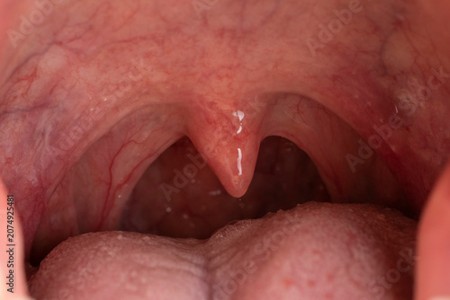 Fotografie Close-up inside view of a human mouth showing the open throat, uvula, soft palate, and tonsils