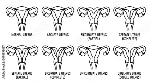 Bild auf Leinwand Uterus Anatomy and Congenital Anomalies Diagram