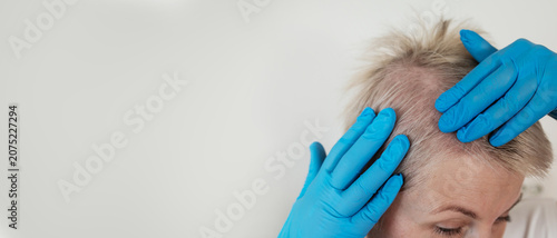 Quadro su tela A close-up of a woman's bald head and her hands in medical gloves