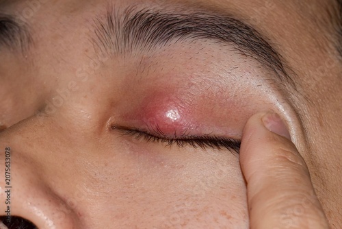Closeup of a red chalazion nodule on an upper eyelid