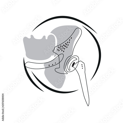 Hip joint replacement anatomy with prosthetic implant illustration and vector