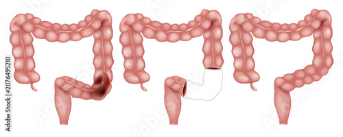 Принти на полотні Rectum Resection with Anastomosis Medical Illustration Showing Colorectal Cancer Surgery Procedure
