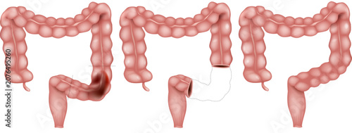 Tableau sur toile Rectum Resection with Anastomosis Medical Illustration Showing Colorectal Cancer Surgery Procedure