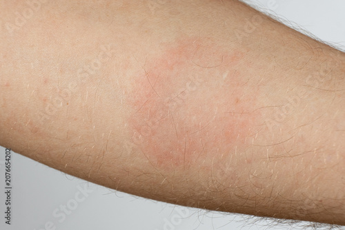 Close-up of a red allergic rash and skin irritation on a patient hand