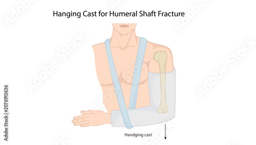 Obraz na plátně Hanging Cast for Humeral Shaft Fracture, the hanging cast technique used for conservative management and alignment of humeral shaft fractures