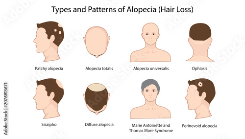 Fotografie Types and Patterns of Alopecia (Hair Loss), the major types and clinical patterns of alopecia, including androgenetic, traction, areata, cicatricial, and diffuse hair loss