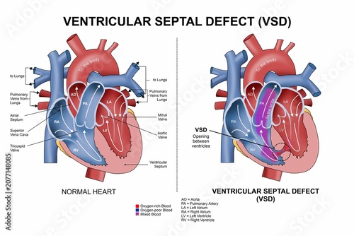 Cuadro en lienzo Ventricular Septal Defect (VSD) Heart Illustration