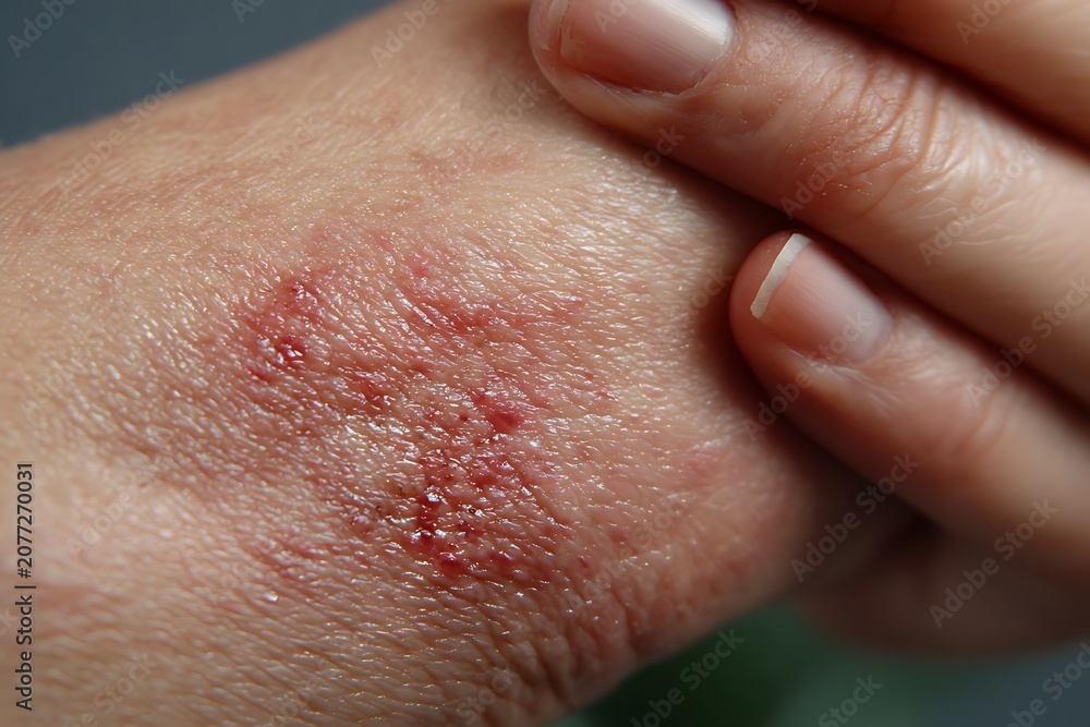 Fototapeta premium Close-up of inflamed irritated skin with redness scratches and spots on human hand or finger