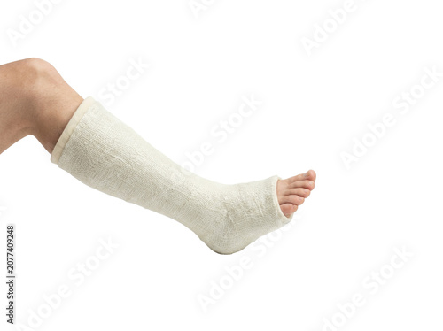 Medical leg cast on injured patient, white fiberglass orthopedic plaster for broken bone recovery, orthopedic leg bandage for fracture healing isolated on Transparent Background