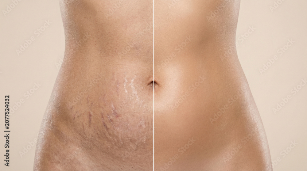 Naklejka premium Female Abdomen Showing Before and After Stretch Mark Reduction