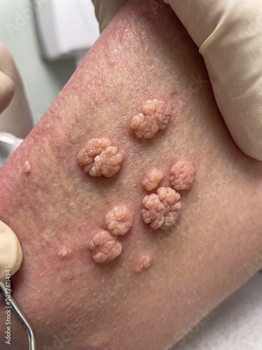 A detailed clinical shot of an HPV infection showing fleshy skin growths shaped like a cockscomb or small cauliflower on the surface of the mucosa, professional photography.